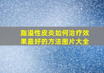 脂溢性皮炎如何治疗效果最好的方法图片大全