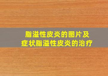 脂溢性皮炎的图片及症状脂溢性皮炎的治疗